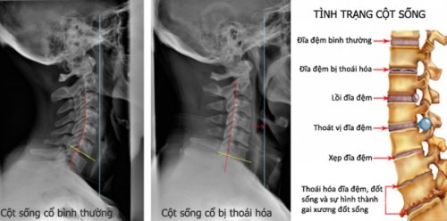 bi-thoai-hoa-dot-song-co.jpg